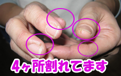 4ヶ所割れた手