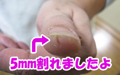 割れた親指