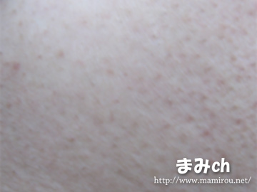 メトセラソープとクリームを使って2週間後